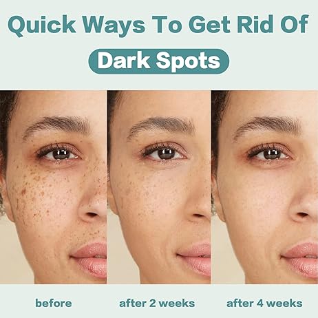 CITYGOO Dark Spot Remover for Face: Dark Spot Corrector Cream - Enriching Skin Care For All Skin Tones - Melasma Freckle Sun Spot Remover & Blemish Reducer-1.7 FL OZ