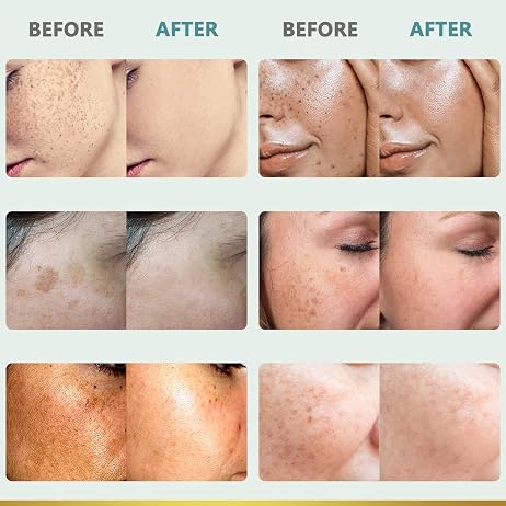 CITYGOO Dark Spot Remover for Face: Dark Spot Corrector Cream - Enriching Skin Care For All Skin Tones - Melasma Freckle Sun Spot Remover & Blemish Reducer-1.7 FL OZ