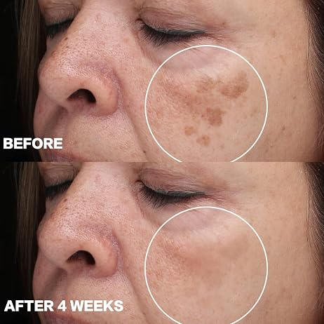 CITYGOO Dark Spot Remover for Face: Dark Spot Corrector Cream - Enriching Skin Care For All Skin Tones - Melasma Freckle Sun Spot Remover & Blemish Reducer-1.7 FL OZ